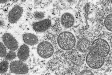 Toronto health authorities investigate first suspected monkeypox case