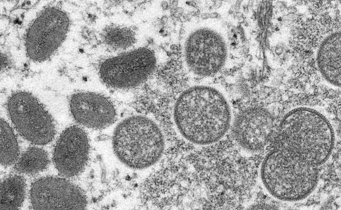 Toronto health authorities investigate first suspected monkeypox case